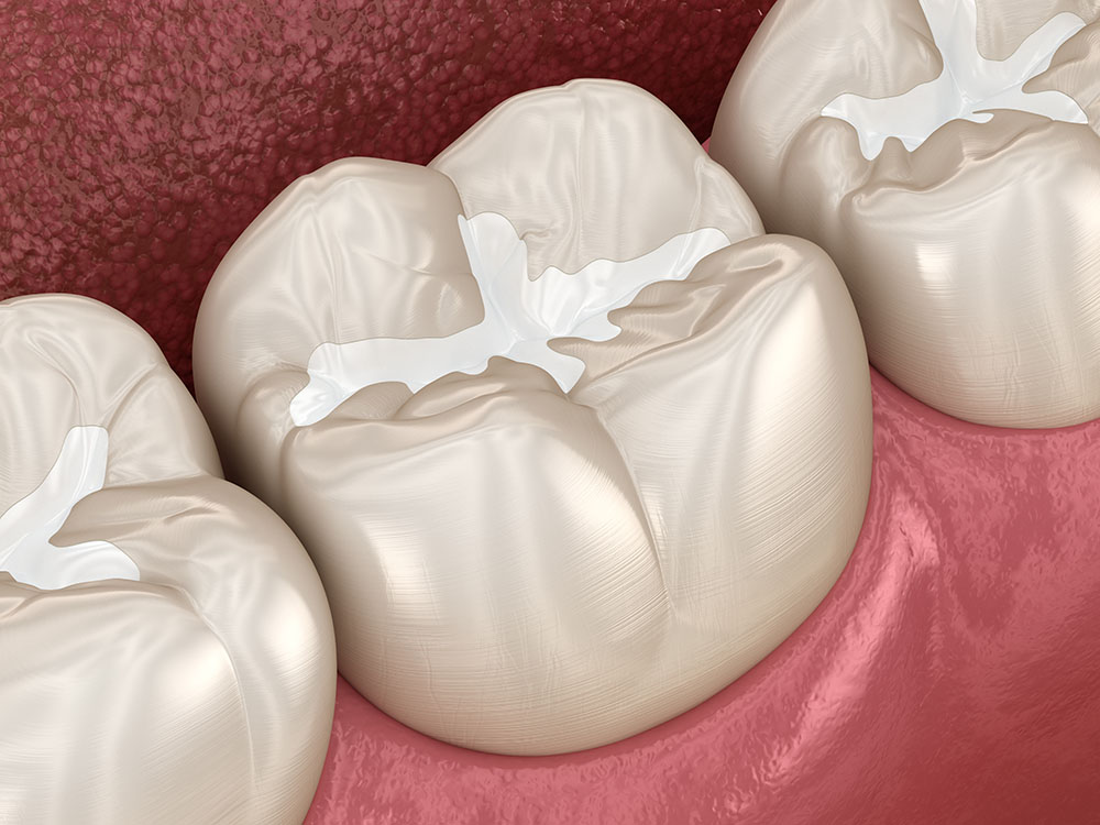 Molar,Fissure,Dental,Fillings,,Medically,Accurate,3d,Illustration,Of,Dental