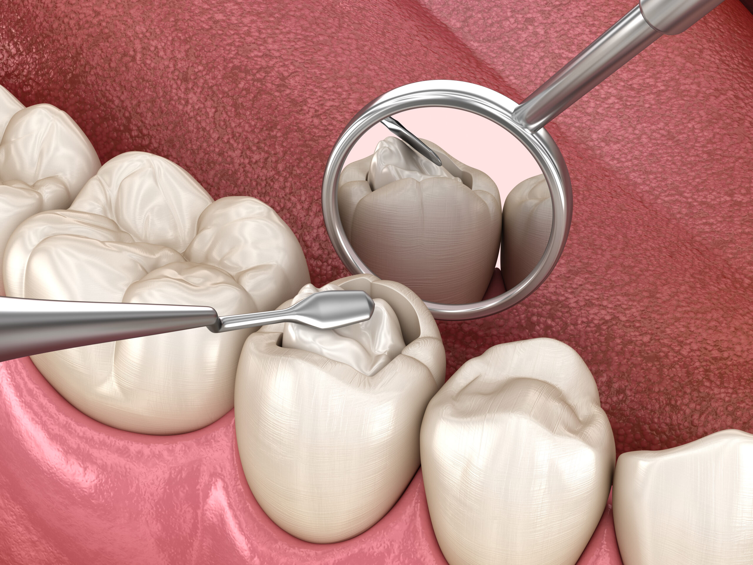 Decayed,Tooth,Restoration,With,Composite,Filling.,Medically,Accurate,Tooth,3d