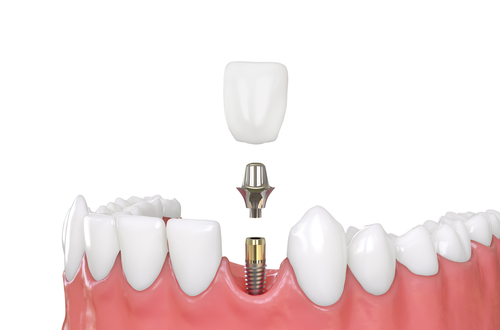 3. Gum_Dental_Implant