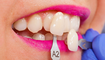 Who-is-a-good-candidate-for-Porcelain-Veneers