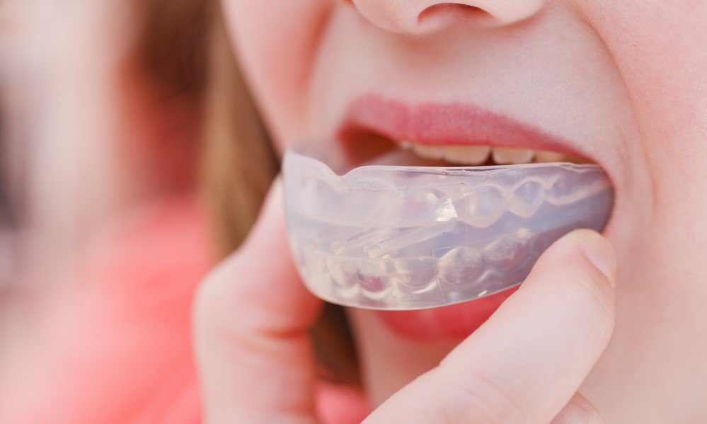 dental-mouthguards-different-kinds