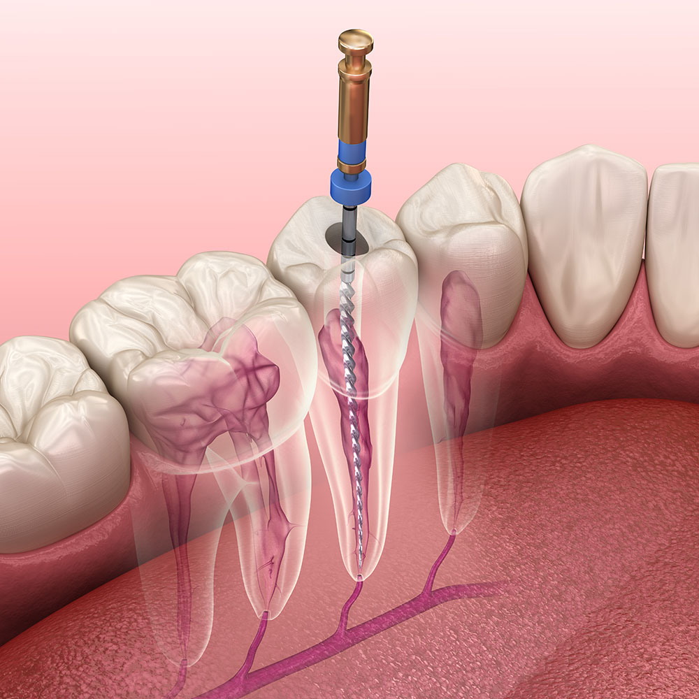 Endodontic,Root,Canal,Treatment,Process.,Medically,Accurate,Tooth,3d,Illustration.